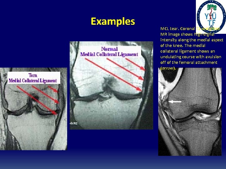 Examples MCL tear. Coronal T 2 -weighted MR image shows high-signal intensity along the Examples MCL tear. Coronal T 2 -weighted MR image shows high-signal intensity along the