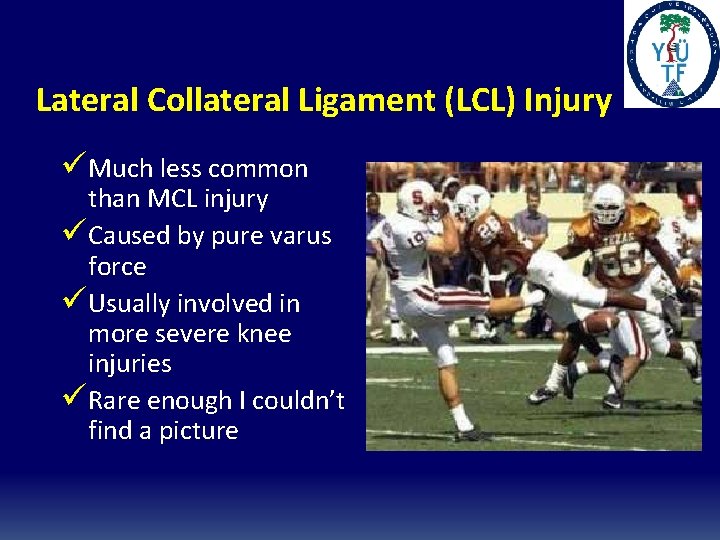 Lateral Collateral Ligament (LCL) Injury üMuch less common than MCL injury üCaused by pure Lateral Collateral Ligament (LCL) Injury üMuch less common than MCL injury üCaused by pure