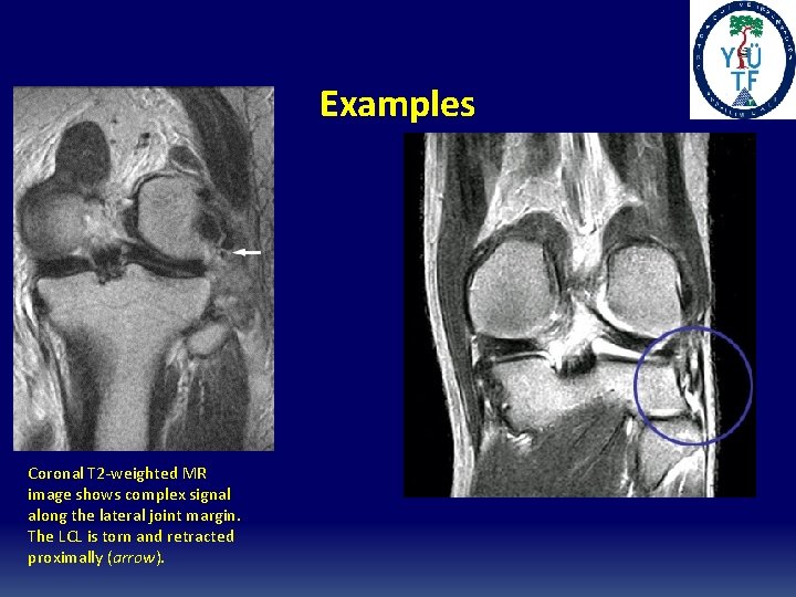 Examples Coronal T 2 -weighted MR image shows complex signal along the lateral joint Examples Coronal T 2 -weighted MR image shows complex signal along the lateral joint