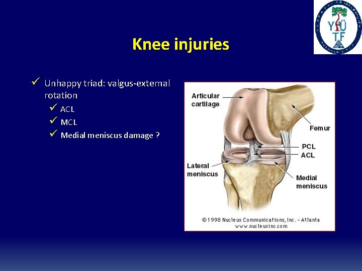 Knee injuries ü Unhappy triad: valgus-external rotation ü ACL ü Medial meniscus damage ? Knee injuries ü Unhappy triad: valgus-external rotation ü ACL ü Medial meniscus damage ?