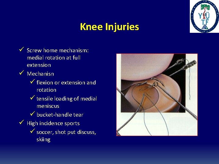 Knee Injuries ü Screw home mechanism: ü ü medial rotation at full extension Mechanisn Knee Injuries ü Screw home mechanism: ü ü medial rotation at full extension Mechanisn