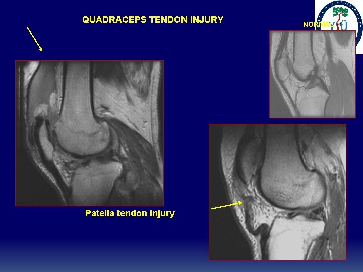 QUADRACEPS TENDON INJURY Patella tendon injury NORMAL QUADRACEPS TENDON INJURY Patella tendon injury NORMAL