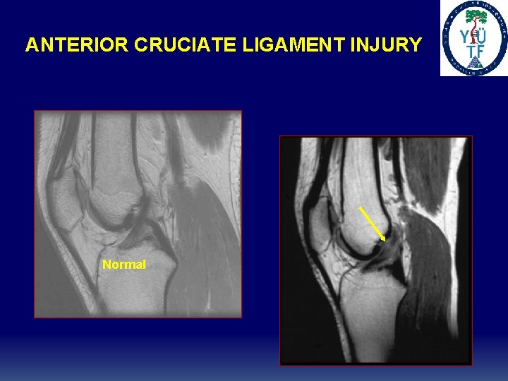 ANTERIOR CRUCIATE LIGAMENT INJURY Normal ANTERIOR CRUCIATE LIGAMENT INJURY Normal