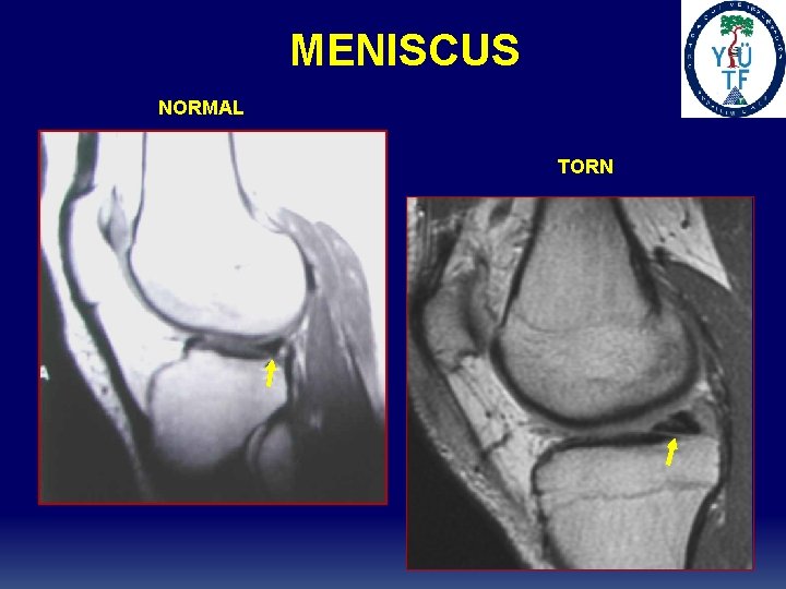 MENISCUS NORMAL TORN MENISCUS NORMAL TORN