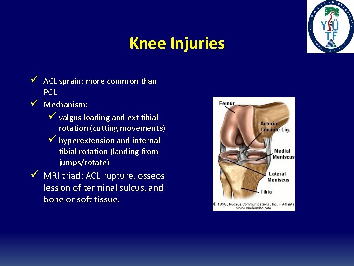 Knee Injuries ü ACL sprain: more common than ü PCL Mechanism: ü valgus loading Knee Injuries ü ACL sprain: more common than ü PCL Mechanism: ü valgus loading