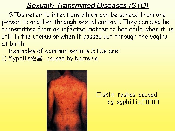 Sexually Transmitted Diseases (STD) STDs refer to infections which can be spread from one