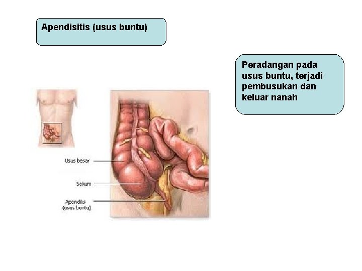 Apendisitis (usus buntu) Peradangan pada usus buntu, terjadi pembusukan dan keluar nanah Apendisitis (usus buntu) Peradangan pada usus buntu, terjadi pembusukan dan keluar nanah
