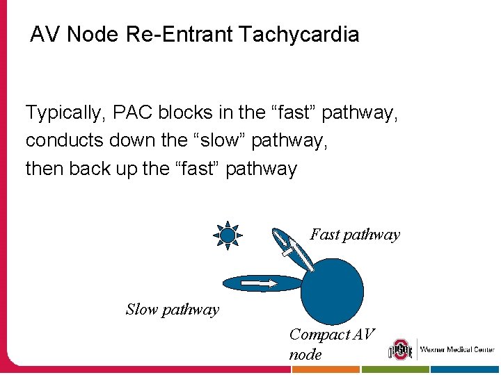 AV Node Re-Entrant Tachycardia Typically, PAC blocks in the “fast” pathway, conducts down the