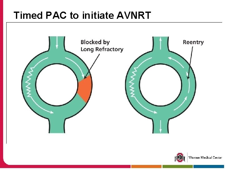 Timed PAC to initiate AVNRT 