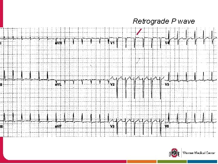 Retrograde P wave 