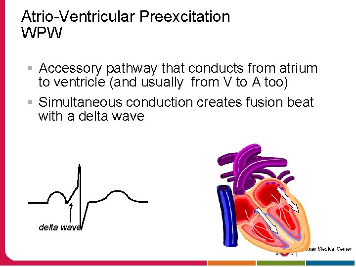 Atrio-Ventricular Preexcitation WPW § Accessory pathway that conducts from atrium to ventricle (and usually