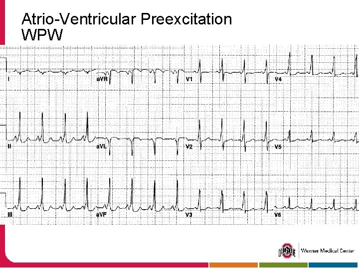 Atrio-Ventricular Preexcitation WPW 