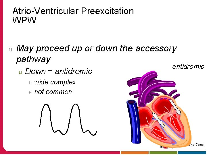 Atrio-Ventricular Preexcitation WPW n May proceed up or down the accessory pathway u Down