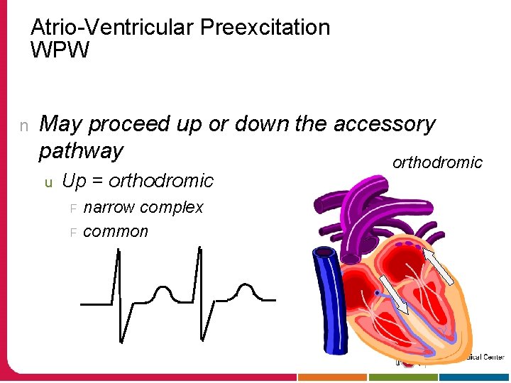 Atrio-Ventricular Preexcitation WPW n May proceed up or down the accessory pathway orthodromic u