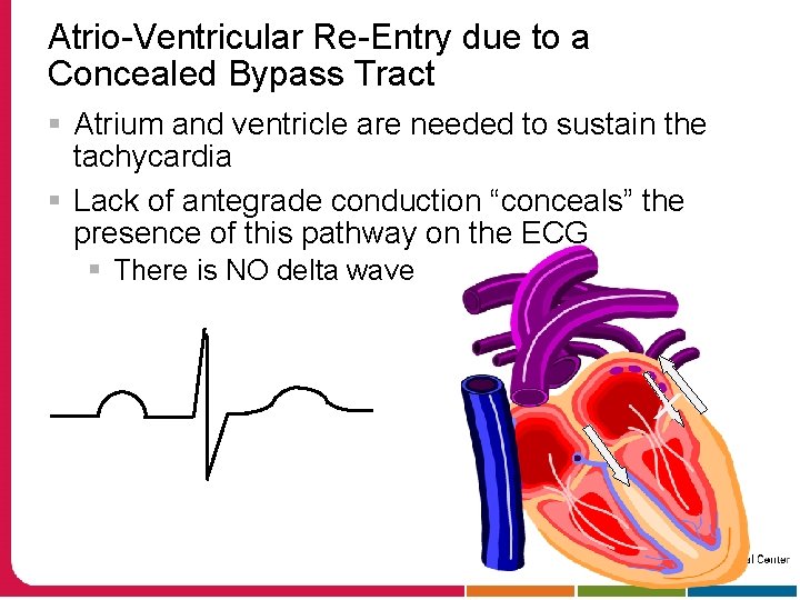 Atrio-Ventricular Re-Entry due to a Concealed Bypass Tract § Atrium and ventricle are needed