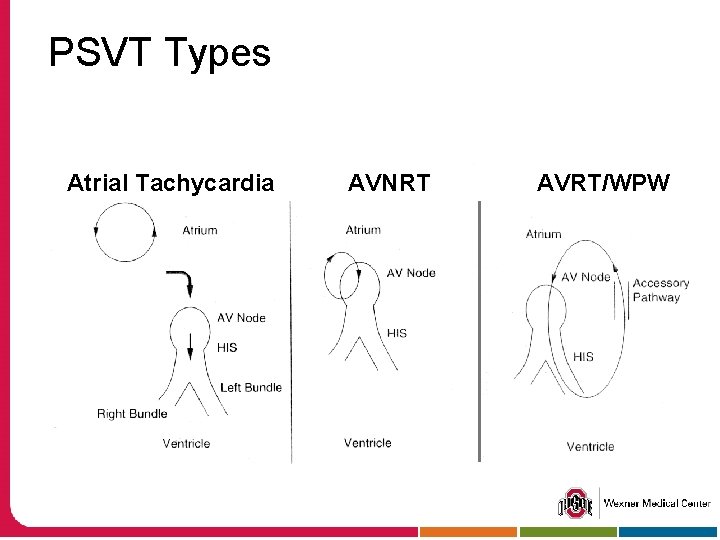 PSVT Types Atrial Tachycardia AVNRT AVRT/WPW 