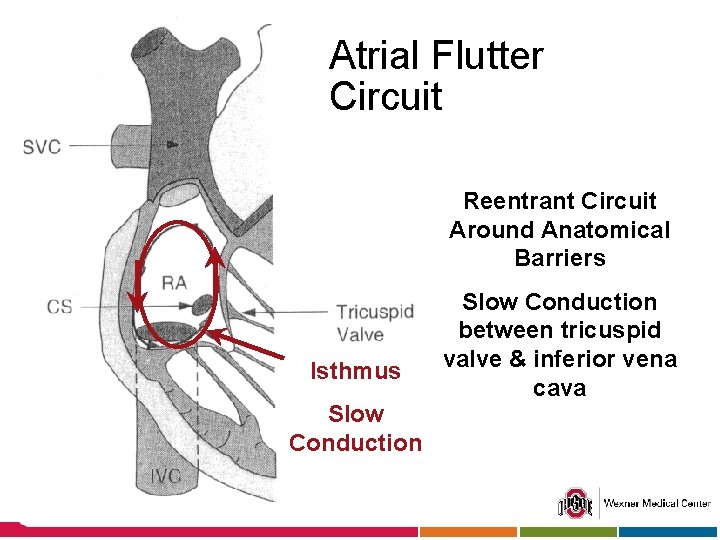 Atrial Flutter Circuit Reentrant Circuit Around Anatomical Barriers Isthmus Slow Conduction between tricuspid valve