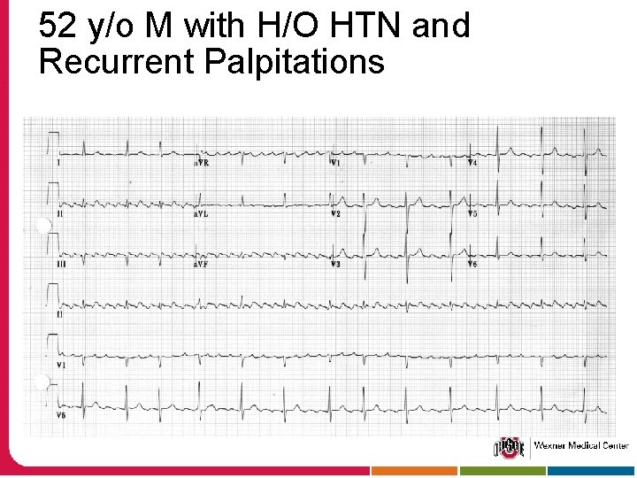 52 y/o M with H/O HTN and Recurrent Palpitations 