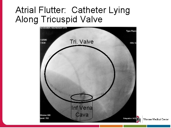 Atrial Flutter: Catheter Lying Along Tricuspid Valve Tri. Valve Inf Vena Cava 