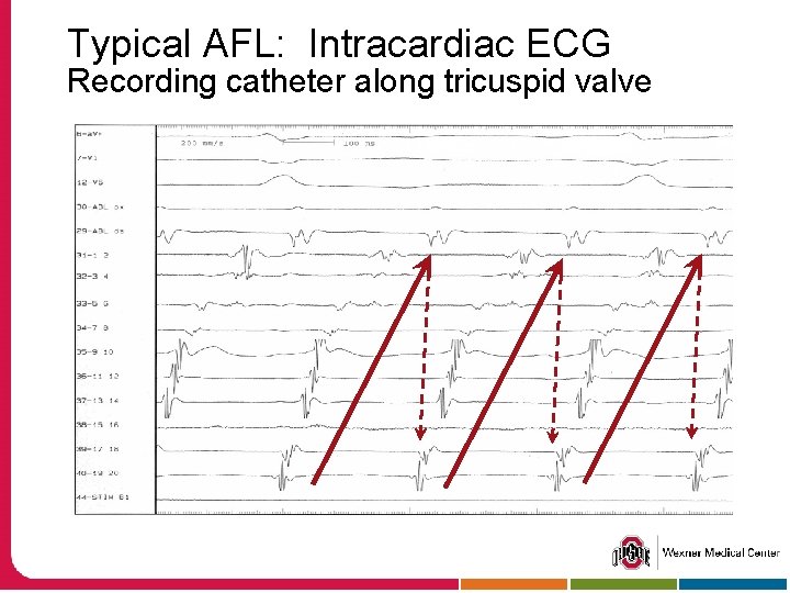 Typical AFL: Intracardiac ECG Recording catheter along tricuspid valve 