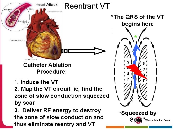 Reentrant VT *The QRS of the VT begins here * Catheter Ablation Procedure: 1.