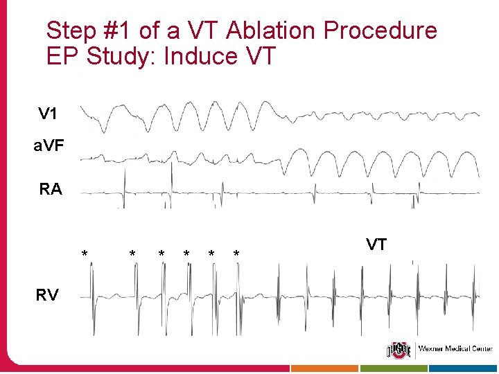 Step #1 of a VT Ablation Procedure EP Study: Induce VT V 1 a.
