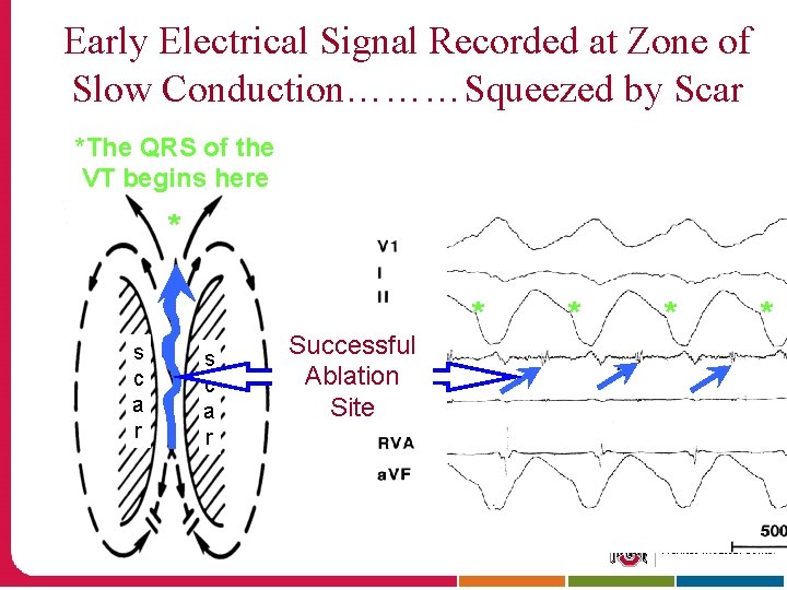 Early Electrical Signal Recorded at Zone of Slow Conduction………Squeezed by Scar *The QRS of