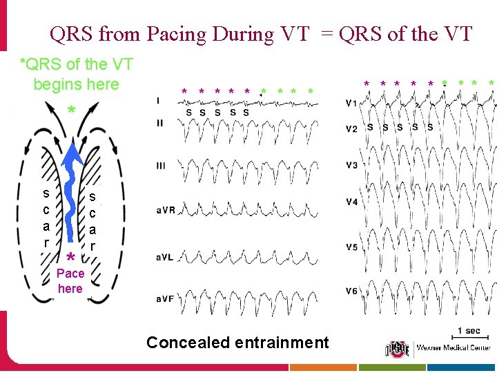 QRS from Pacing During VT = QRS of the VT *QRS of the VT
