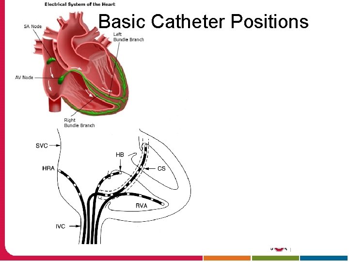 Basic Catheter Positions Protocol for RFA: 1. Catheters introduced via the femoral vein 2.