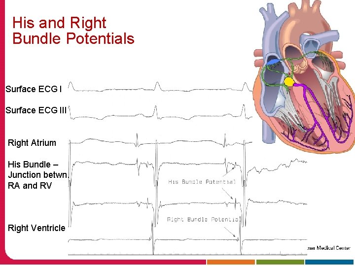 His and Right Bundle Potentials Surface ECG III Right Atrium His Bundle – Junction