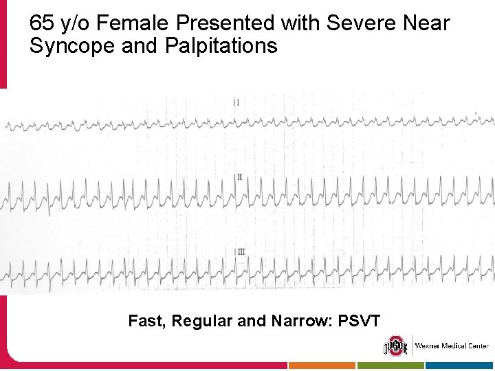 65 y/o Female Presented with Severe Near Syncope and Palpitations Fast, Regular and Narrow: