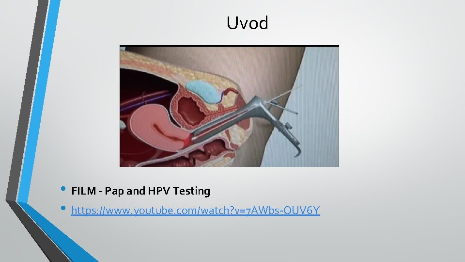 Uvod • FILM - Pap and HPV Testing • https: //www. youtube. com/watch? v=7