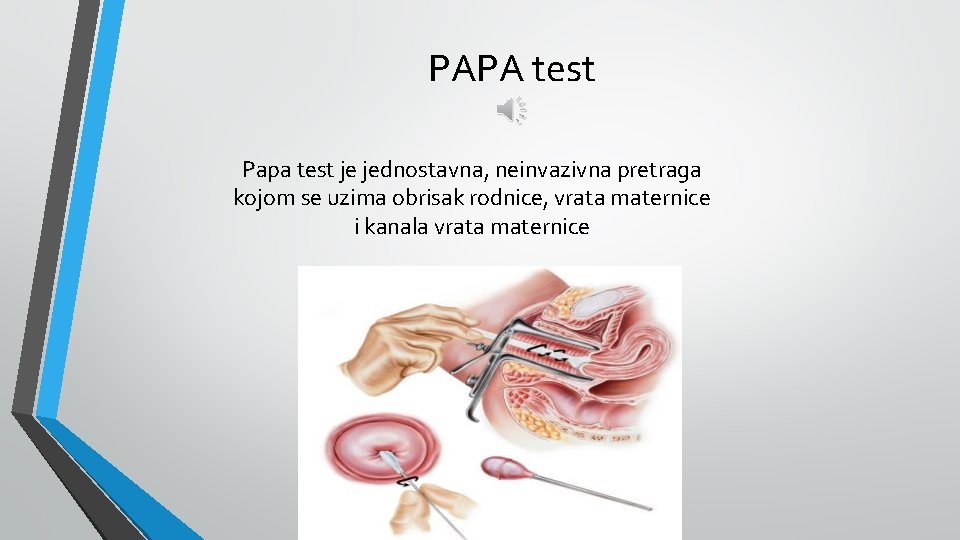 PAPA test Papa test je jednostavna, neinvazivna pretraga kojom se uzima obrisak rodnice, vrata