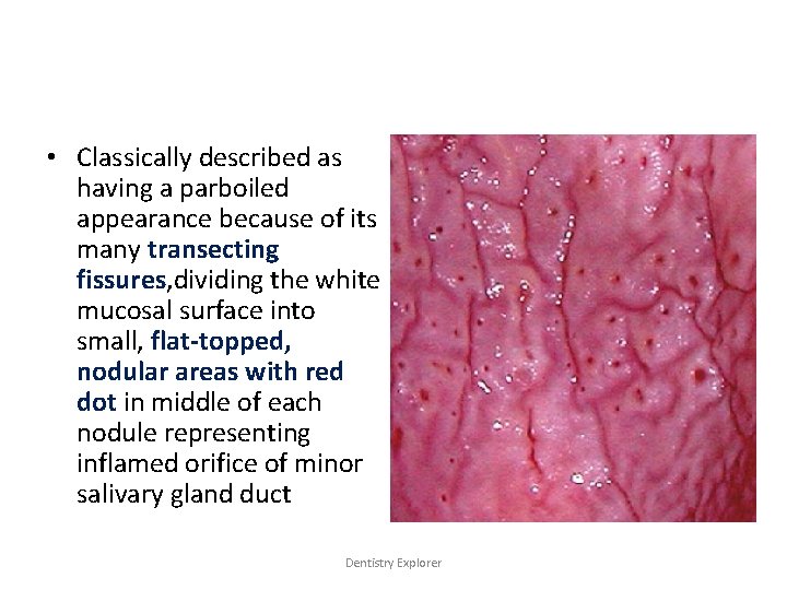  • Classically described as having a parboiled appearance because of its many transecting