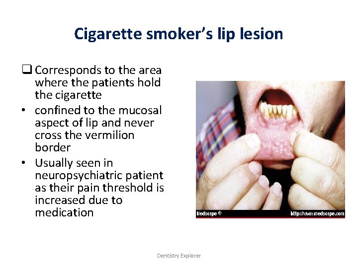 Cigarette smoker’s lip lesion q Corresponds to the area where the patients hold the