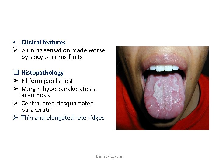  • Clinical features Ø burning sensation made worse by spicy or citrus fruits