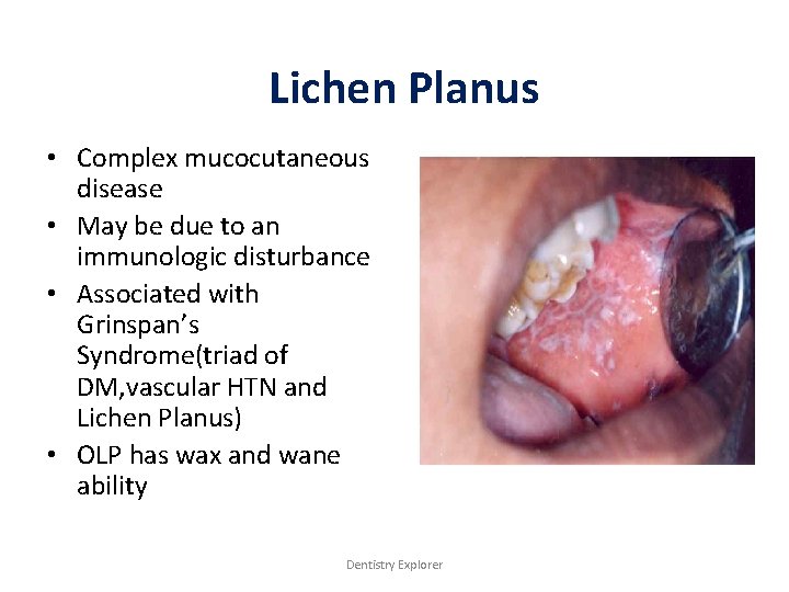 Lichen Planus • Complex mucocutaneous disease • May be due to an immunologic disturbance