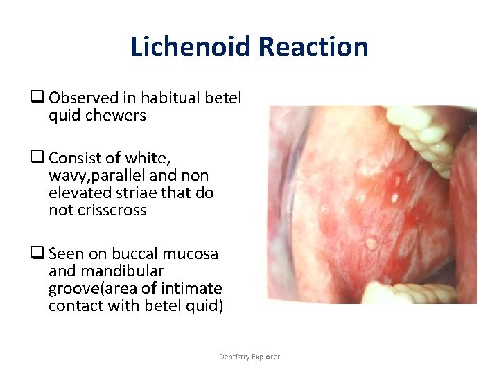 Lichenoid Reaction q Observed in habitual betel quid chewers q Consist of white, wavy,