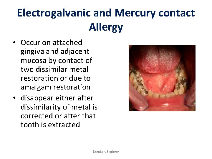 Electrogalvanic and Mercury contact Allergy • Occur on attached gingiva and adjacent mucosa by