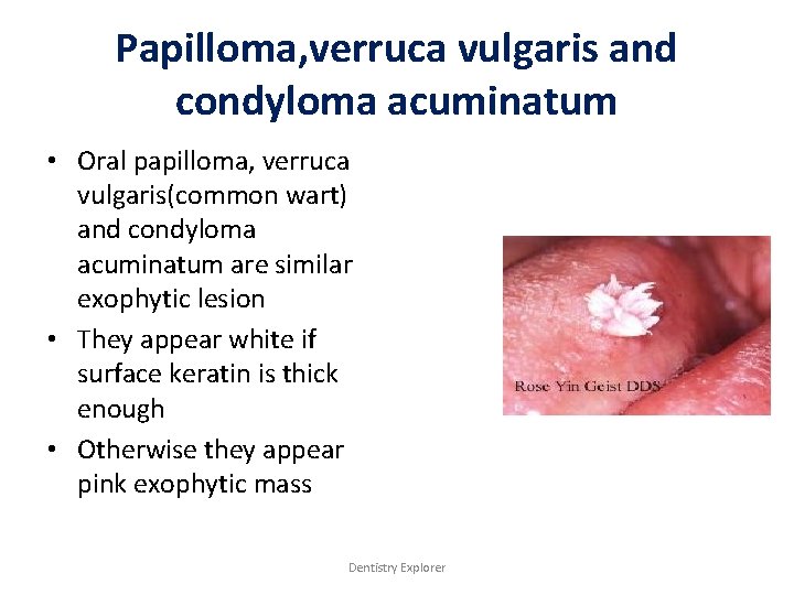 Papilloma, verruca vulgaris and condyloma acuminatum • Oral papilloma, verruca vulgaris(common wart) and condyloma