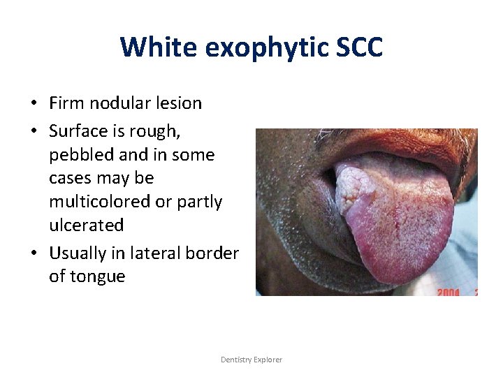 White exophytic SCC • Firm nodular lesion • Surface is rough, pebbled and in