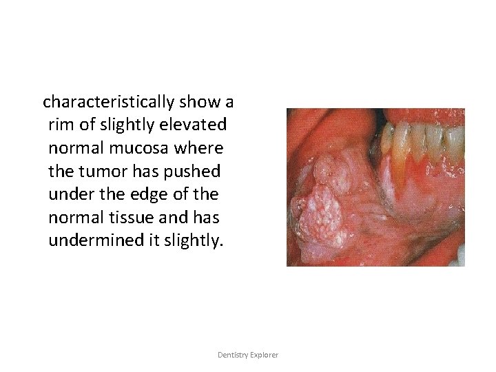 characteristically show a rim of slightly elevated normal mucosa where the tumor has pushed