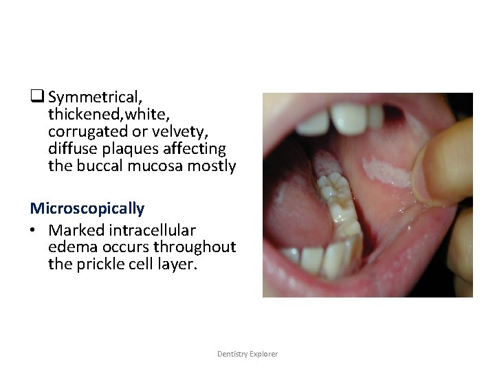 q Symmetrical, thickened, white, corrugated or velvety, diffuse plaques affecting the buccal mucosa mostly