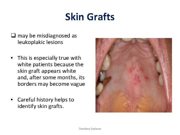 Skin Grafts q may be misdiagnosed as leukoplakic lesions • This is especially true