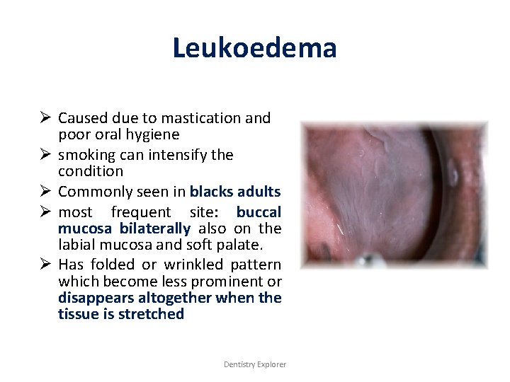 Leukoedema Ø Caused due to mastication and poor oral hygiene Ø smoking can intensify