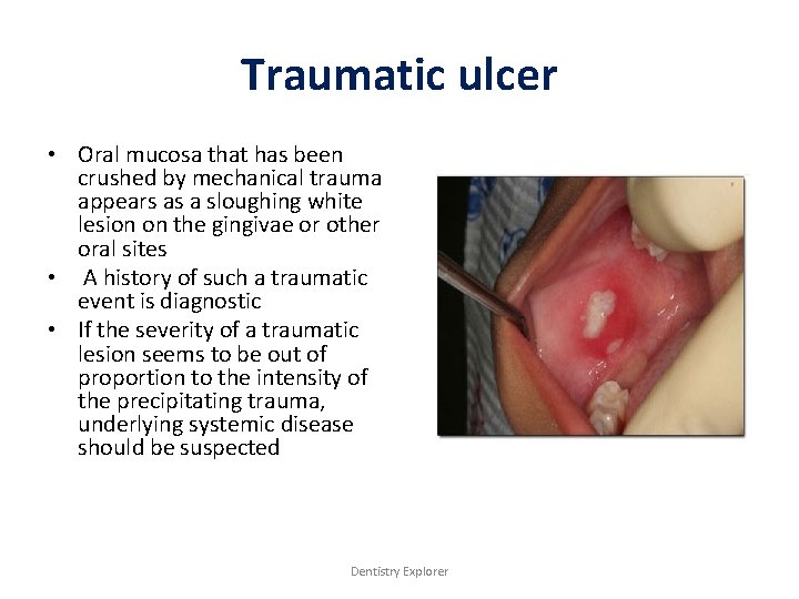 Traumatic ulcer • Oral mucosa that has been crushed by mechanical trauma appears as