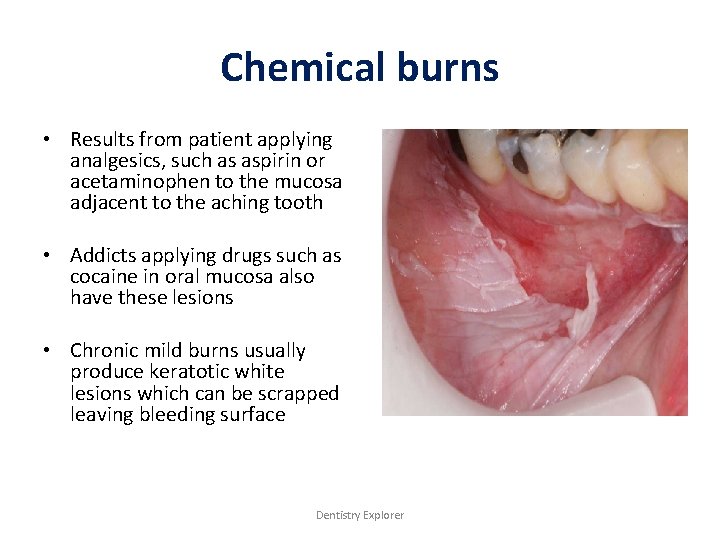 Chemical burns • Results from patient applying analgesics, such as aspirin or acetaminophen to