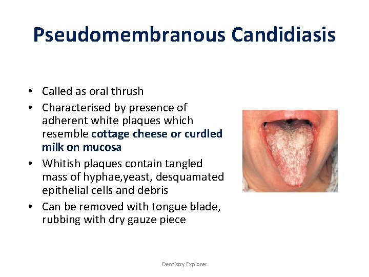 Pseudomembranous Candidiasis • Called as oral thrush • Characterised by presence of adherent white