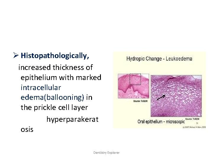 Ø Histopathologically, increased thickness of epithelium with marked intracellular edema(ballooning) in the prickle cell