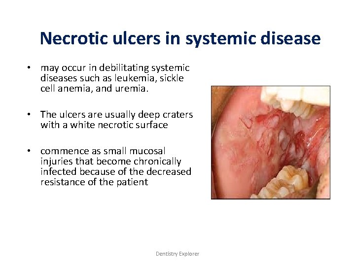 Necrotic ulcers in systemic disease • may occur in debilitating systemic diseases such as